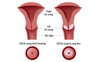 9 câu hỏi về ung thư cổ tử cung chị em cần biết 1